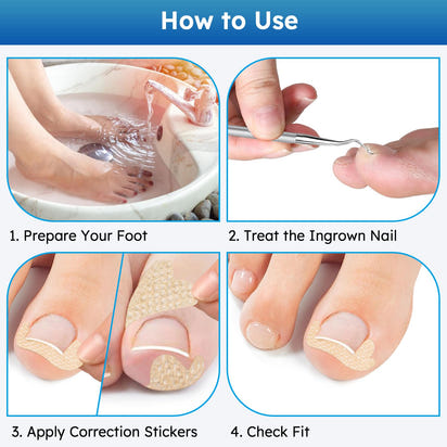 Comfort Care Ingrown Toenail Corrector™