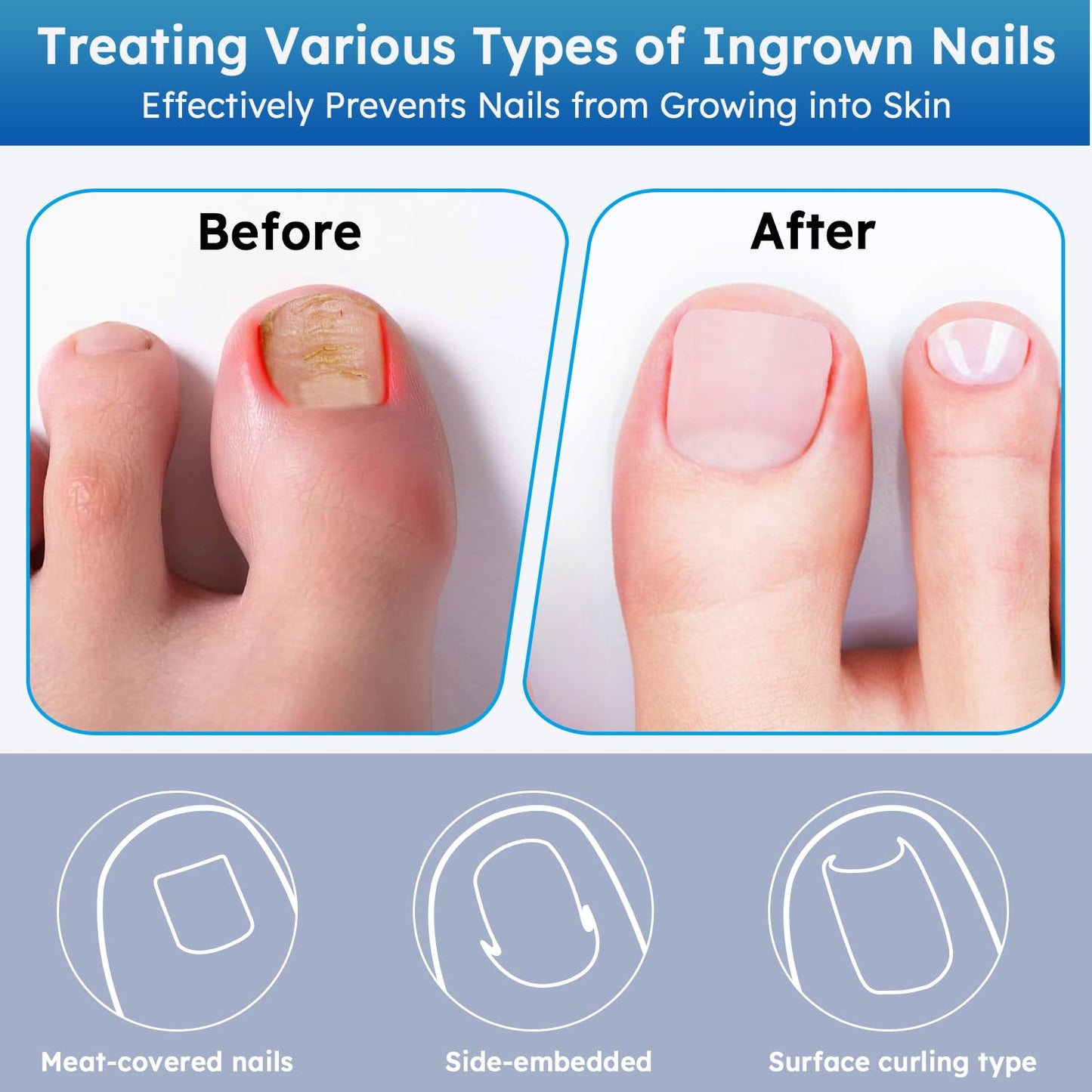 Comfort Care Ingrown Toenail Corrector™
