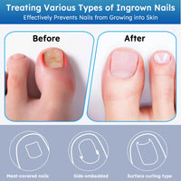 Comfort Care Ingrown Toenail Corrector™
